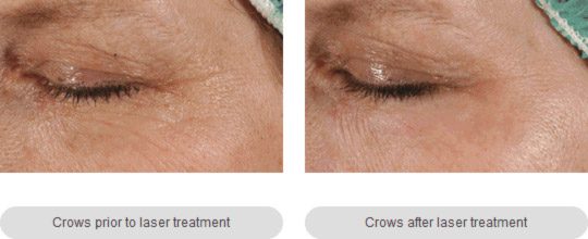 Laser-Facial-Regeneration-